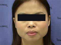 Jaw Contouring Surgery